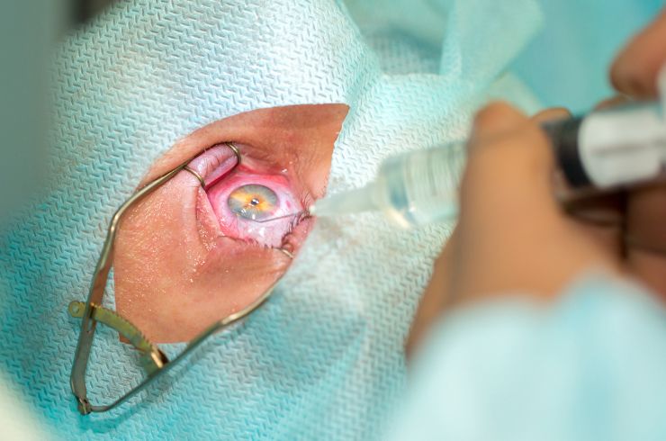 Cataract surgery