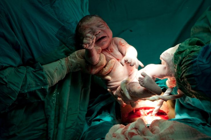 Normal and Cesarean Delivery